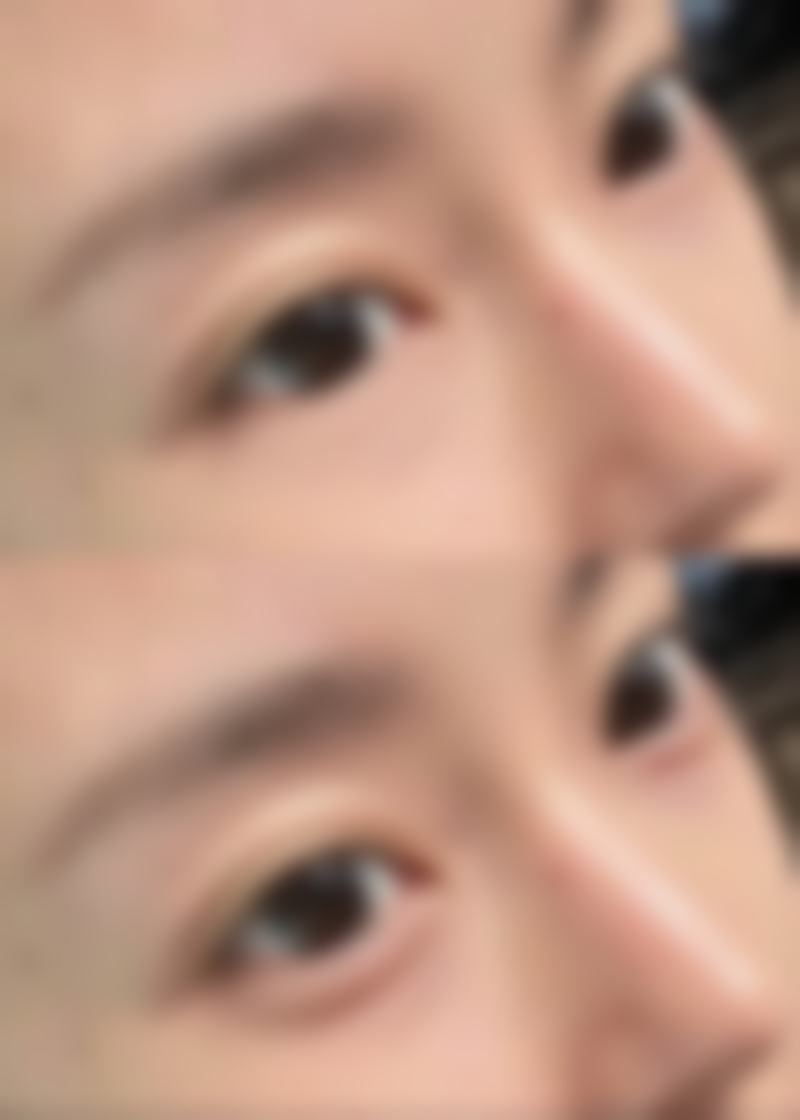 哪些因素会影响瘦脸针的注射频率?