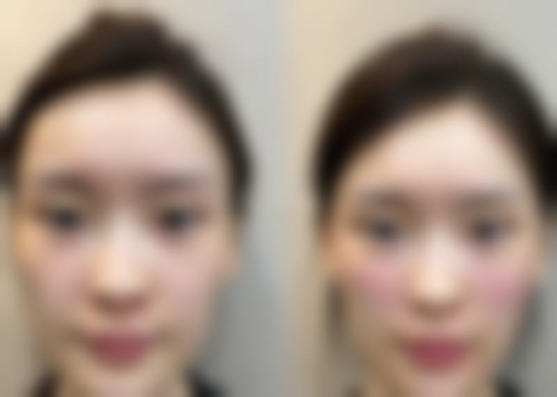 种植头发2000单位的面积和头发浓密程度有什么关系?