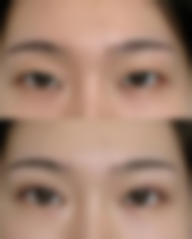 不同类型的凸起疤痕，用祛疤膏后成效如何呢？