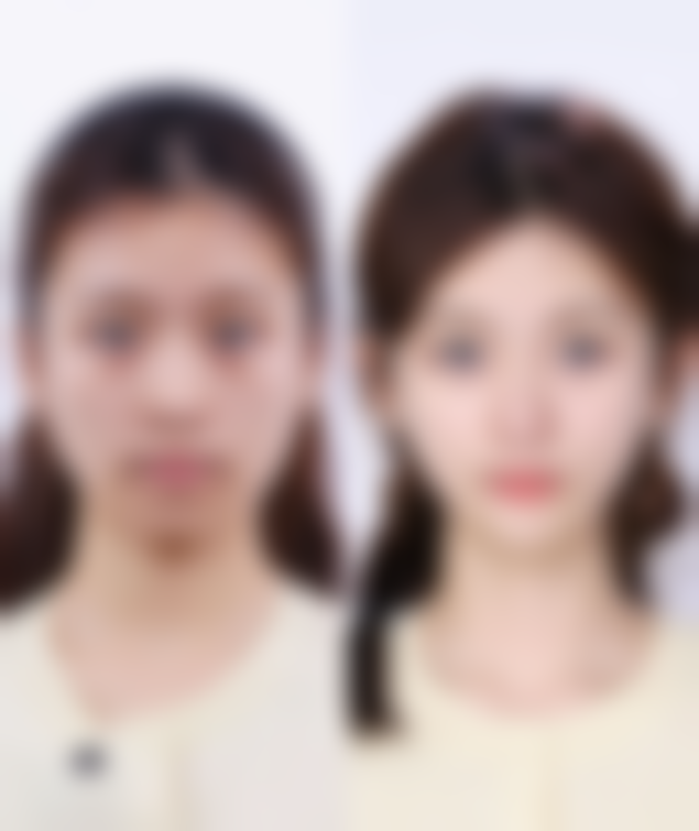 为什么双眼皮宽改窄手术要选择正规医院的专精医生呢？