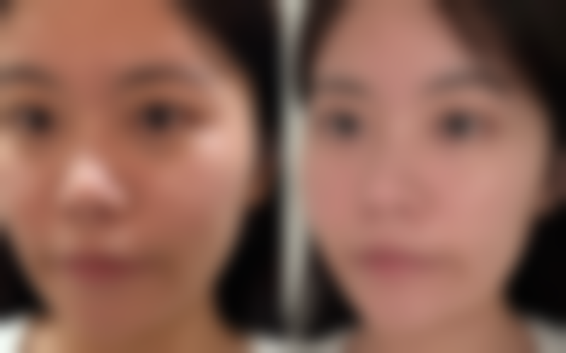 哪些特殊人群在进行双眼皮宽改窄修复手术时需要特别注意呢？