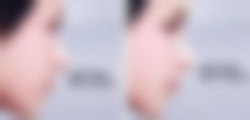 吸脂范围和吸脂量对身体伤害有什么影响?