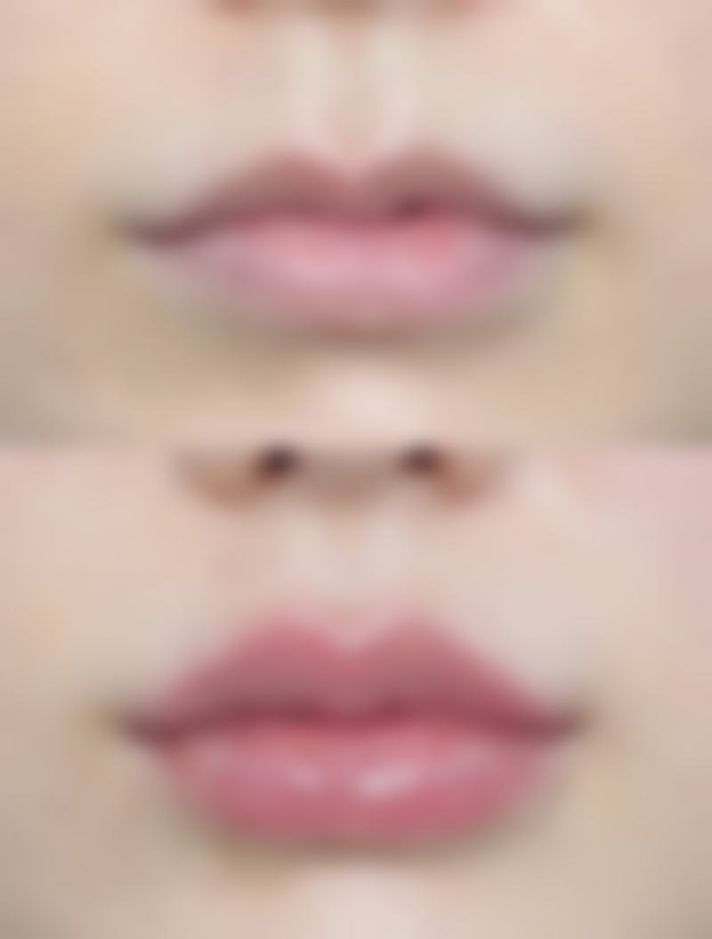 深圳整形医院有哪些注射类去眼袋方案?