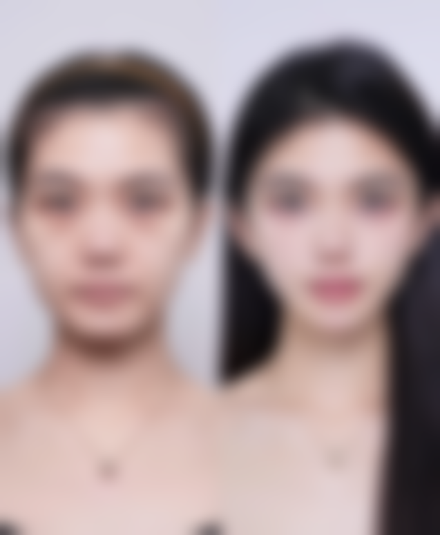 在正规医院做抽脂手术,对身体伤害一般大吗?