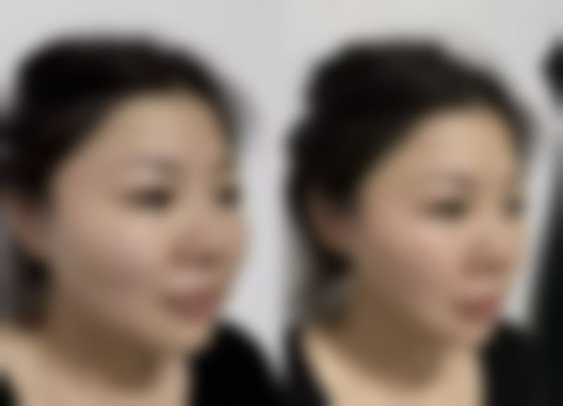 吸脂手术有生命危险吗？正规操作下风险可控，该如何降低潜在风险你知道吗？ 