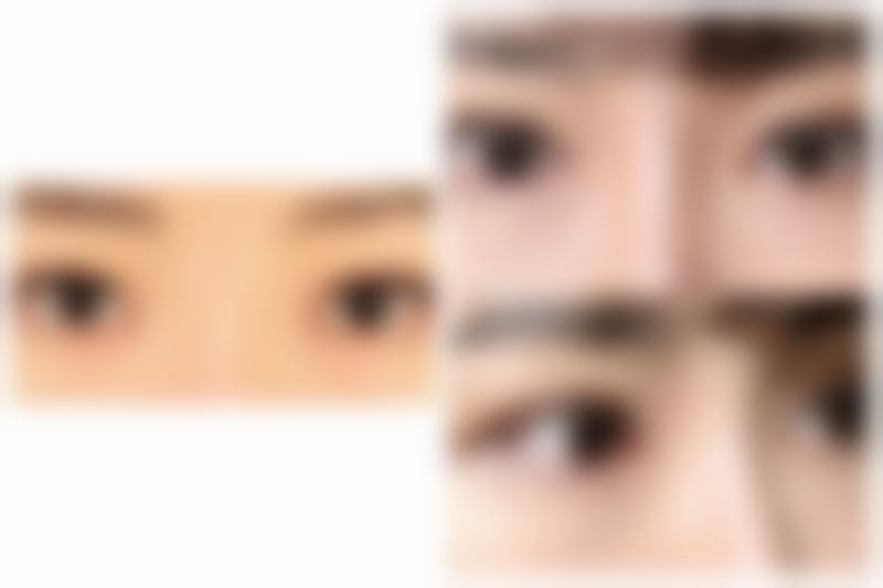 该如何选择适合自己的去眼袋方法呢？