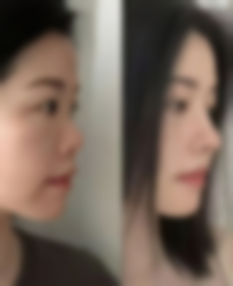 医院对于隆胸手术有哪些相关建议?