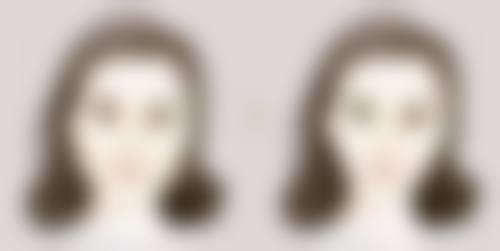 点阵激光能完全去除疤痕吗？答案是部分可显著改善，但完全去除受多种因素影响 