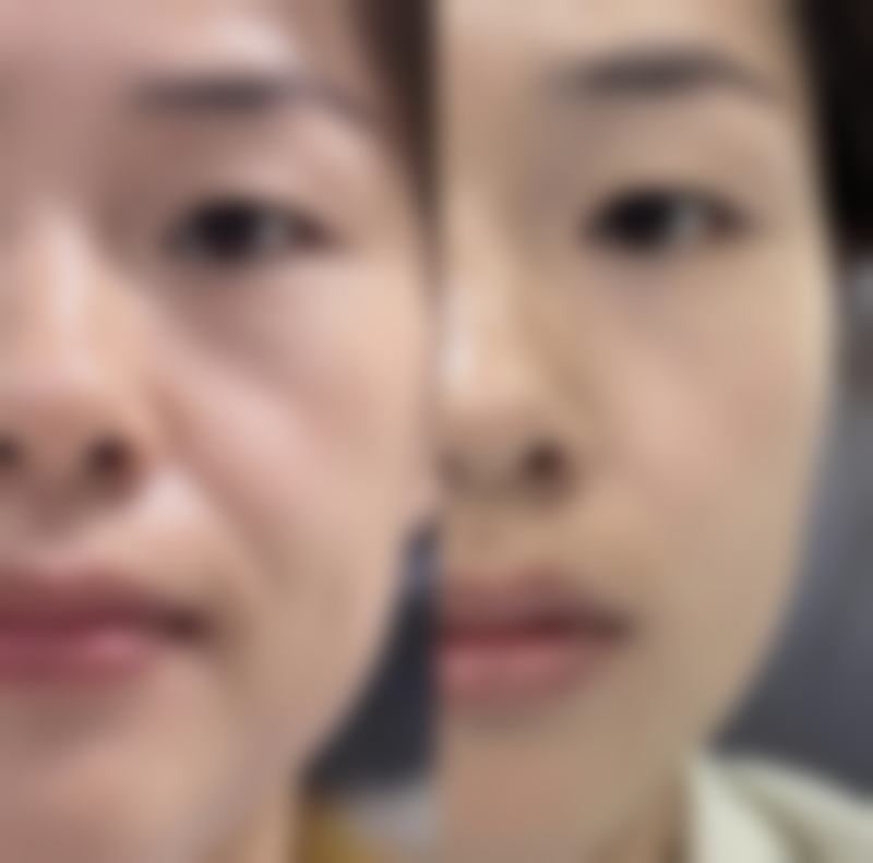 眼袋溶脂后都凹进去了怎么办？可通过填充修复、调整作息，还需注意这些护理要点！ 