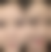 大腿吸脂手术会不会反弹？科学术后护理下大概率不反弹，效果持久有保障！ 