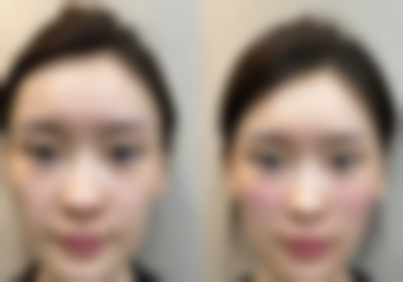 那通常用什么方法来修复凹陷呢？