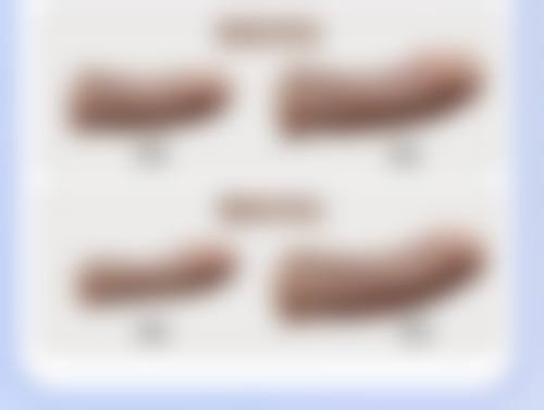 割双眼皮手术痛不痛呢？