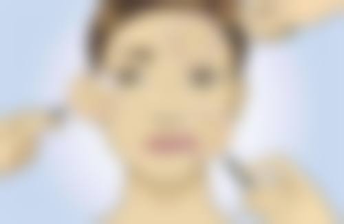 多位医生对于割双眼皮35天是否需要忌口有哪些观点?