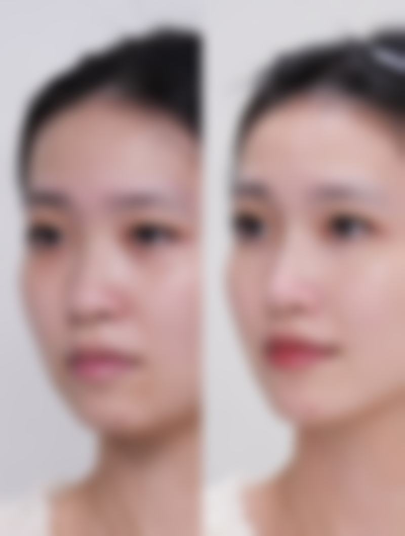 去除眼袋对视功能有什么优化作用？