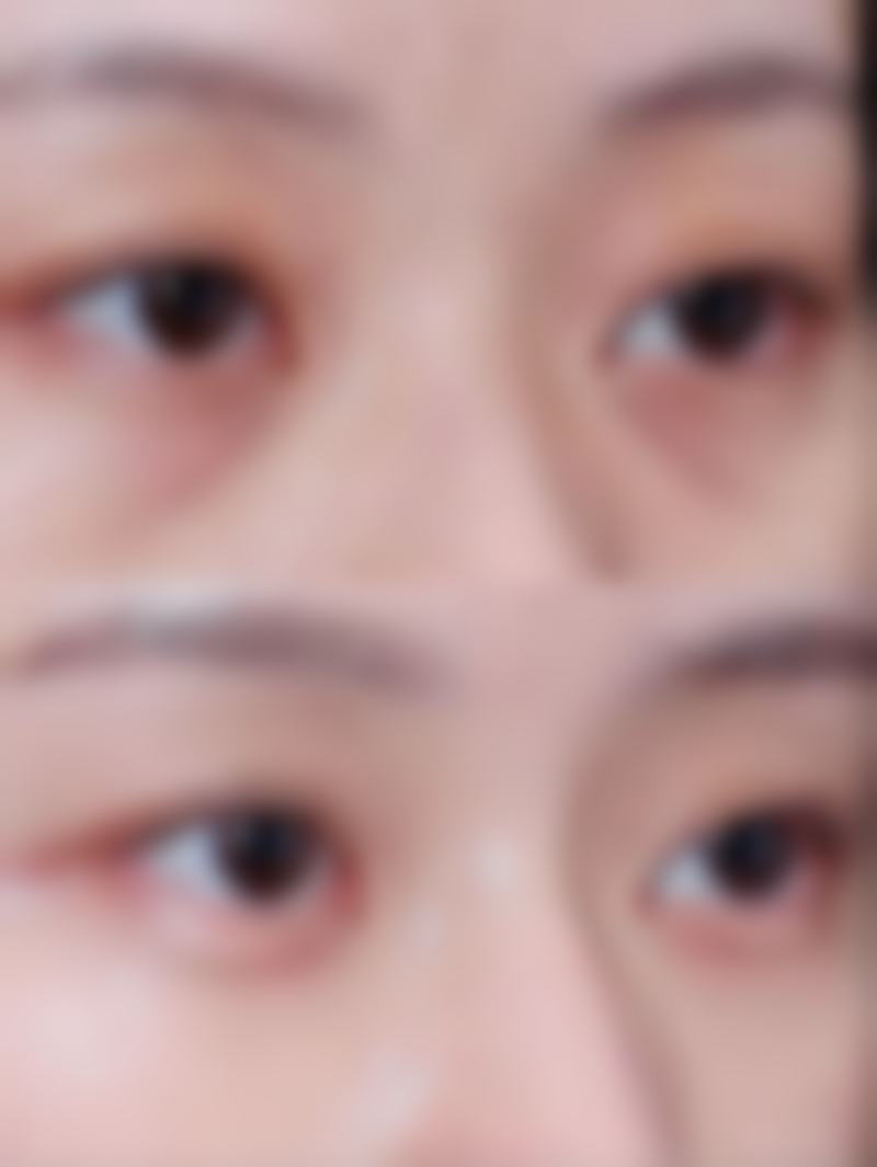 怎么样最有效去眼袋？按摩、医美手术、调整作息，哪种方法才是你的最佳选择？ 