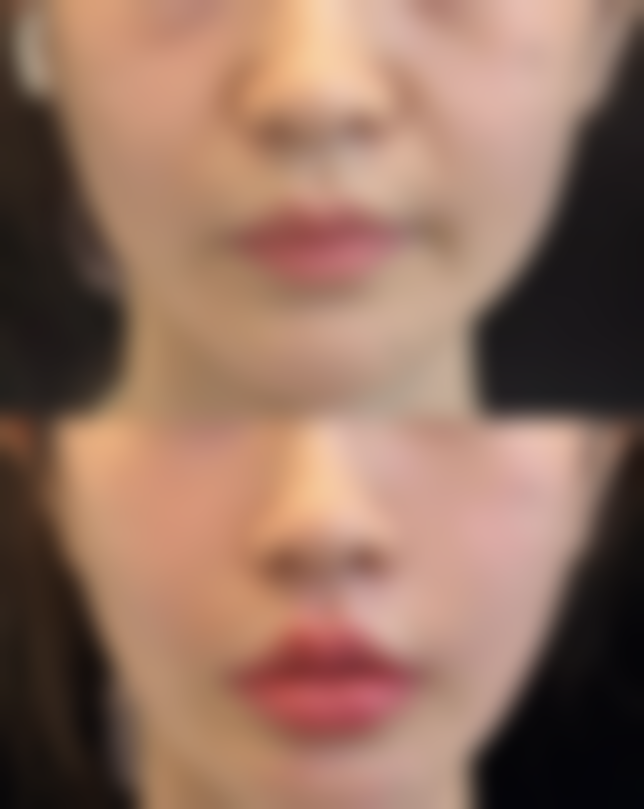 内切法去眼袋有什么优势？