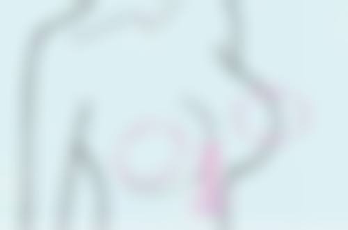 隆鼻做假体还有其他危害吗，怎么减少这些危害的发生？