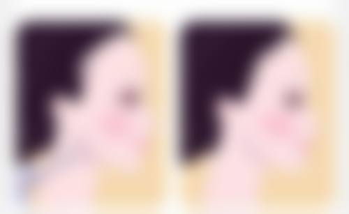 选择假体时，预算方面有什么参考吗？