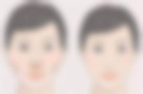 埋线双眼皮的优势有哪些?