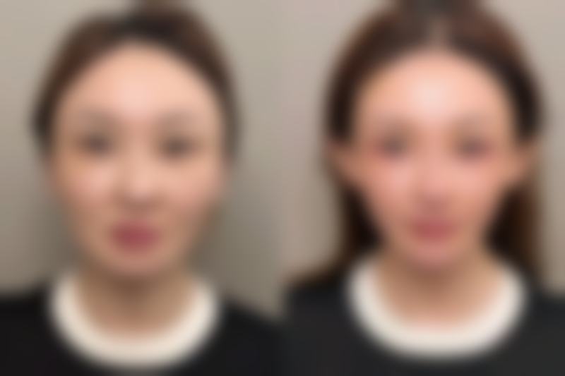 排异反应的发生概率高吗，如何降低这种反应的出现？