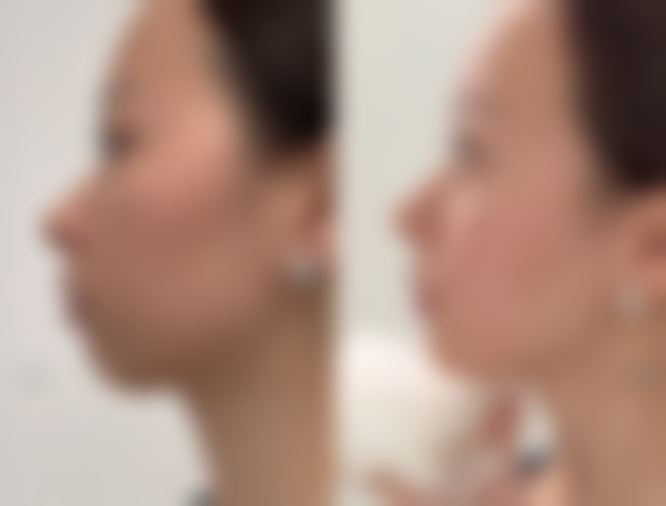 埋线双眼皮修复时间长吗?