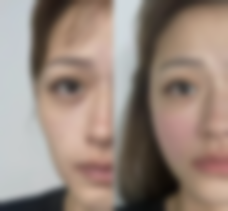 包膜挛缩是怎么回事，能避免吗？