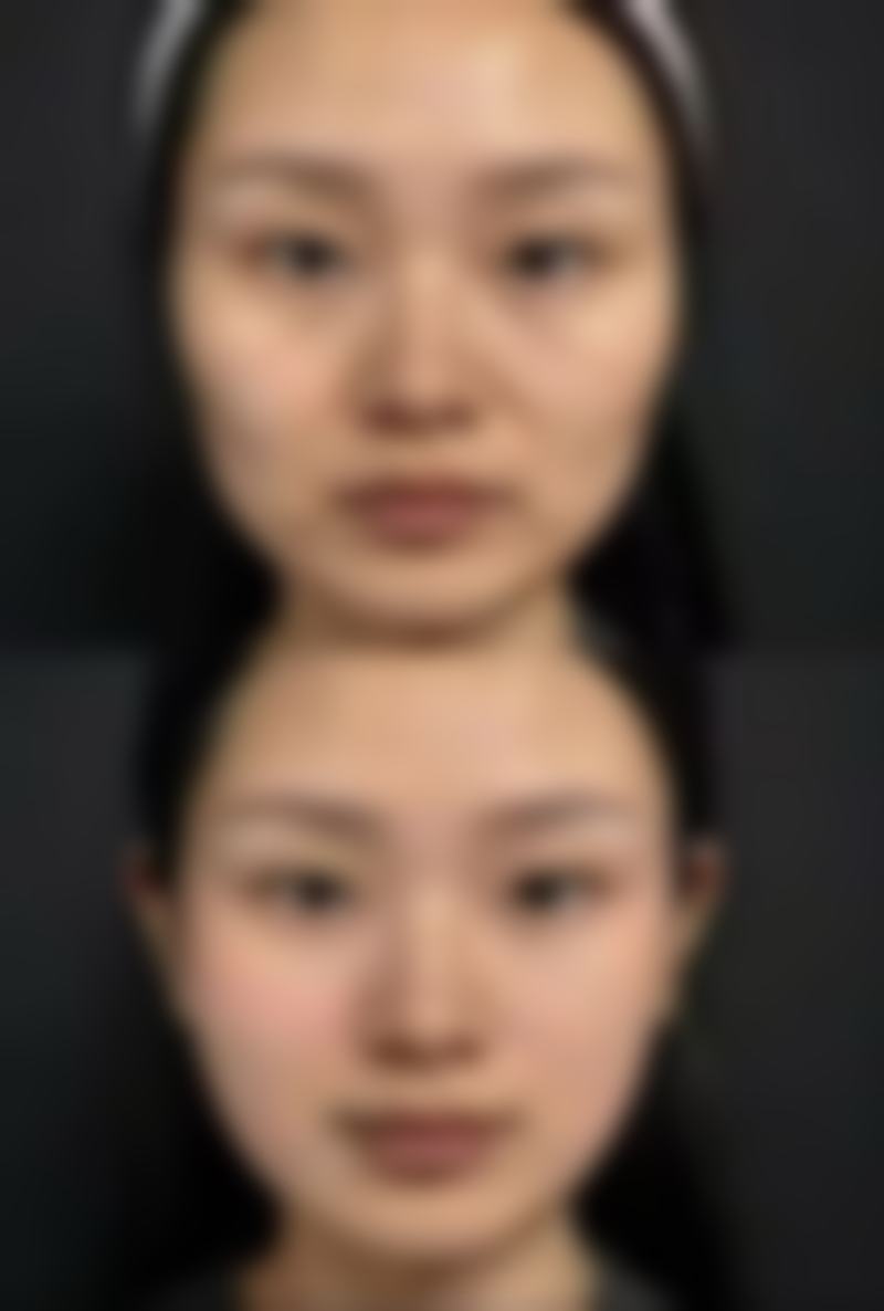 如果色素沉着重度或持久不褪,该怎么办呢?