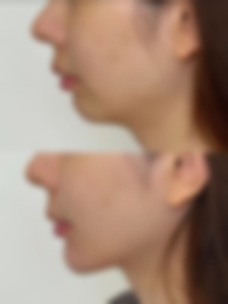 激光溶脂和吸脂分别适合身体的哪些部位呢？