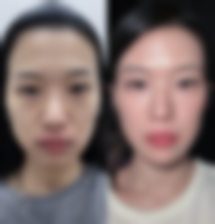 艾灸的疤痕会恢复吗？了解恢复方法与影响因素，助你轻松应对疤痕问题！ 