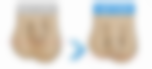 是不是所有人都适合不开刀去眼袋手术呢？