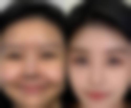 日常护理中需要注意什么来改善疤痕变硬的情况？