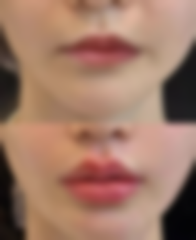 假体隆胸后不同阶段适合的运动有哪些?