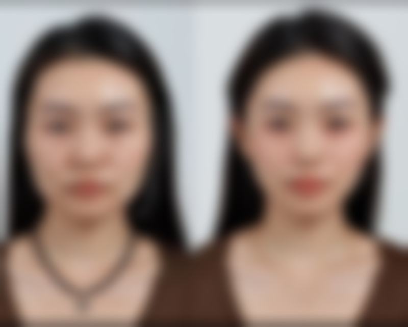 假体隆胸多久可以跳绳？一般术后3 - 6个月，恢复良好时便可适度跳绳 