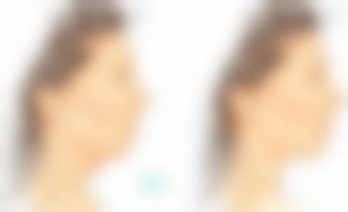 吸脂减肥修复期分为哪些阶段？