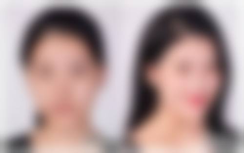 双眼皮宽改窄修复手术适合哪些人？