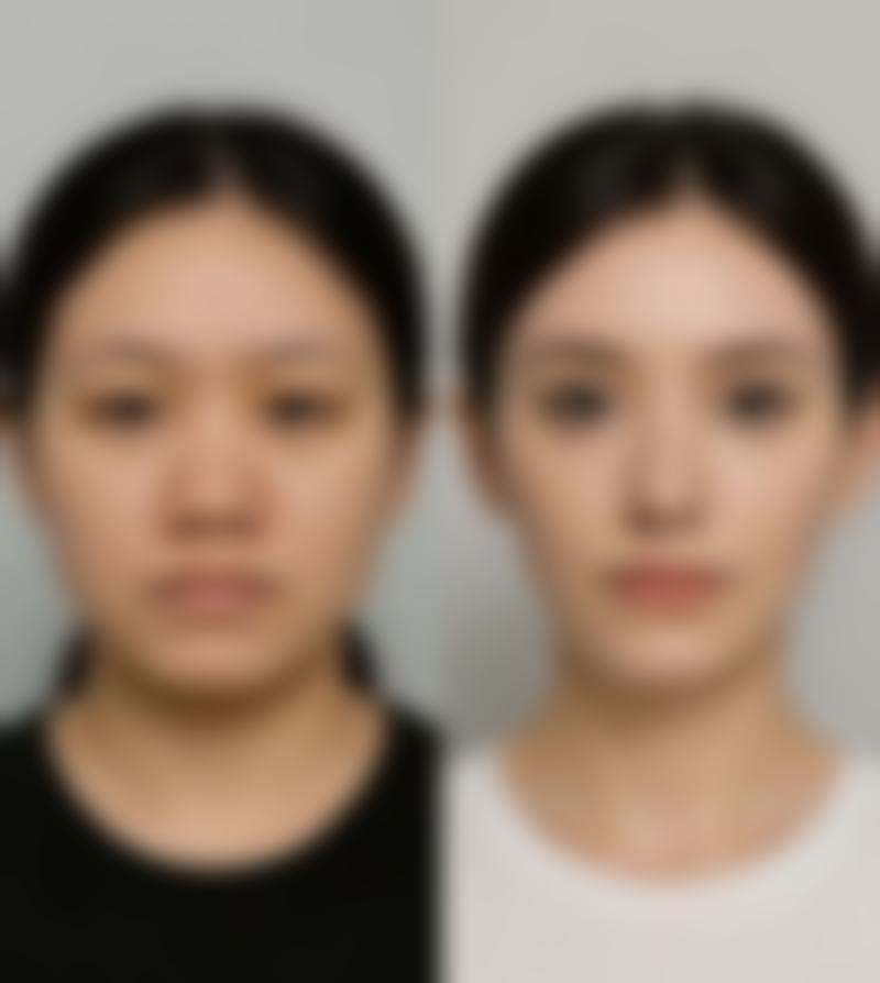 疤痕黑色素激光能去除吗？激光祛疤黑色素效果显著，安全高效助你恢复肌肤光彩！ 