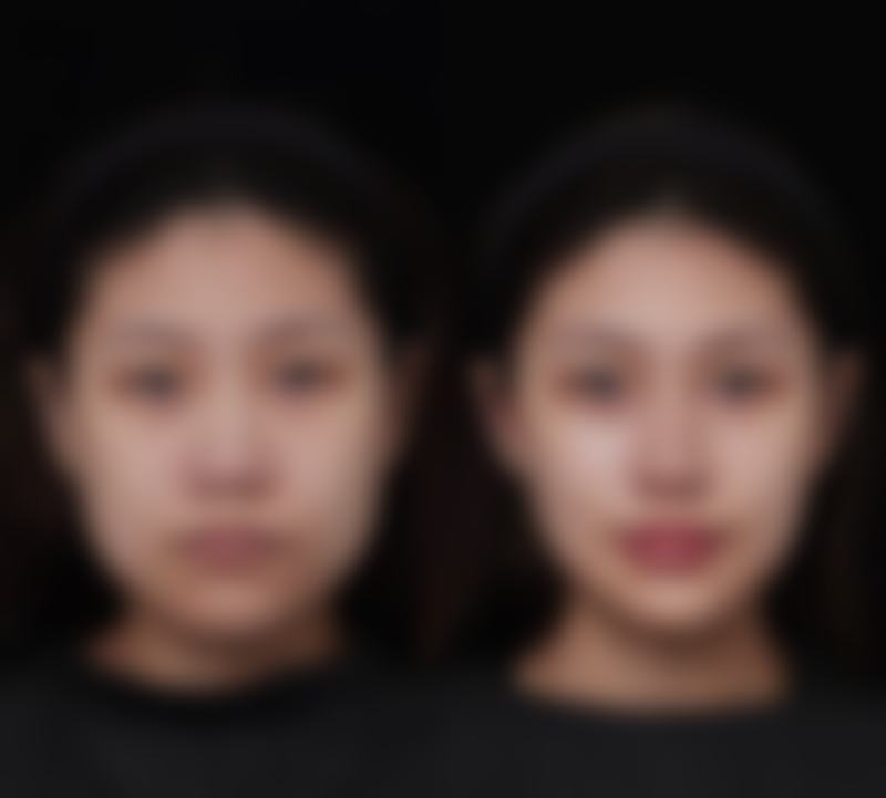 怎样保护吸脂减肥手术的安心性和成效呢？