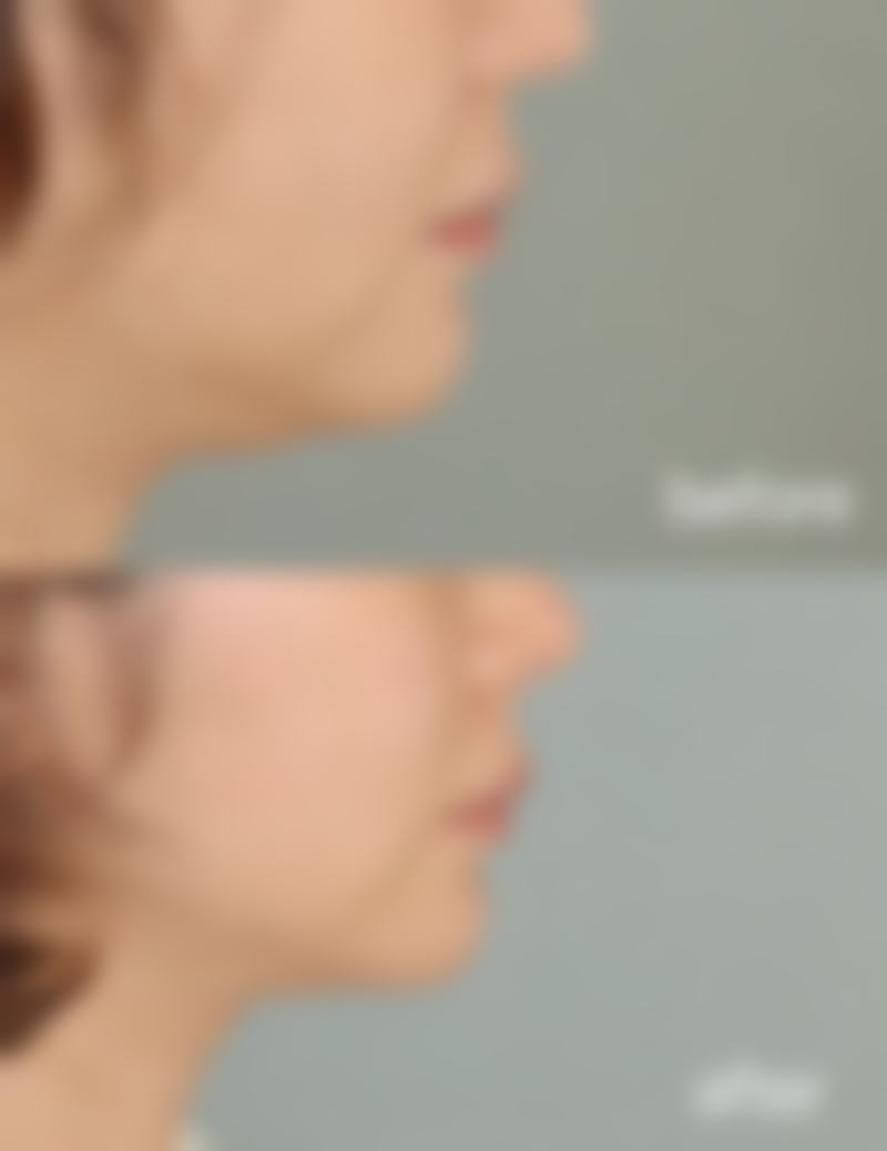 治疗背部疤痕疙瘩后需要注意什么呢?