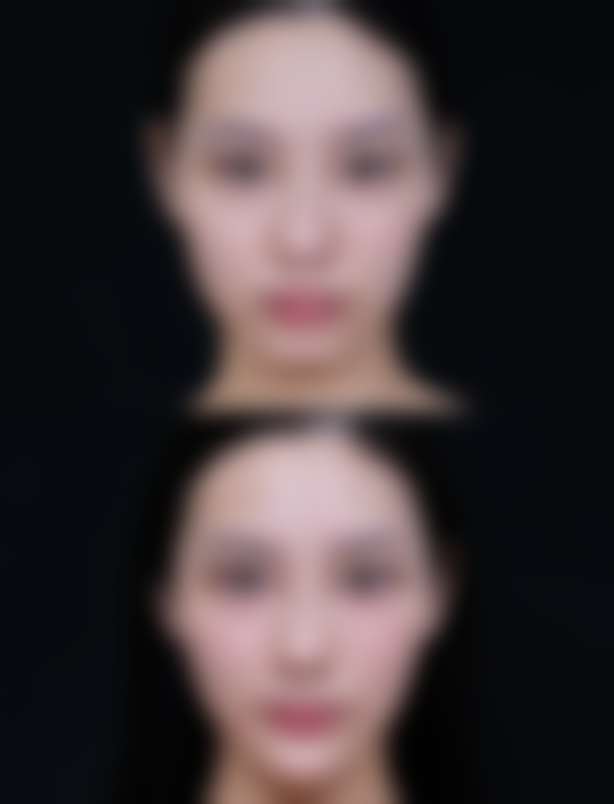 不同状态的背部疤痕疙瘩有哪些推荐的治疗方案?