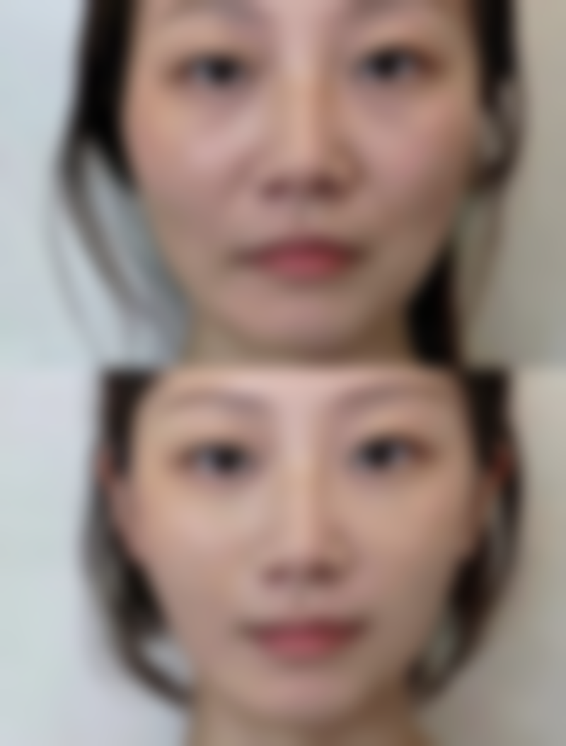 腿部抽脂后不同修复阶段有什么成效变化？