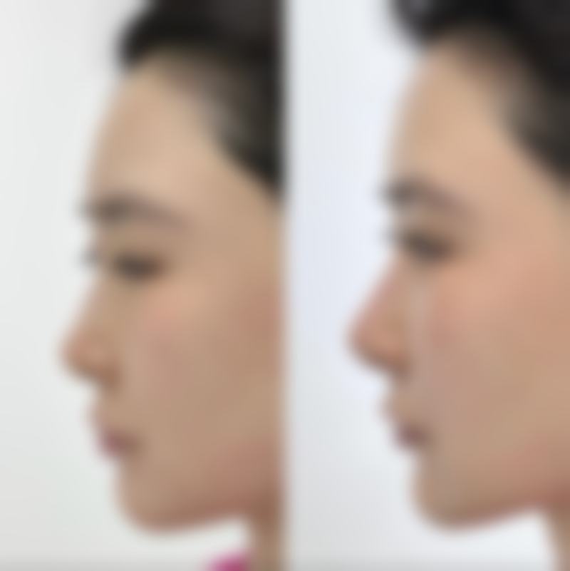 硅胶隆鼻有哪些优点呢？