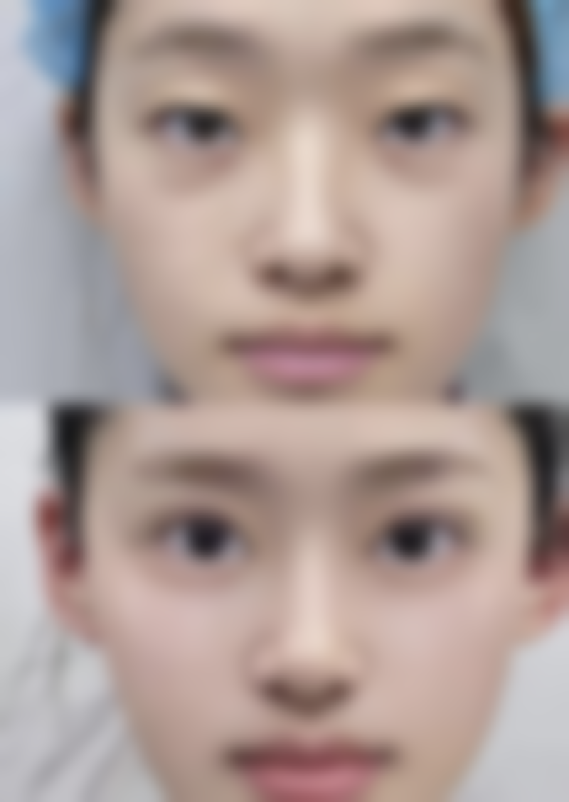 取隆胸假体真的不痛苦吗？