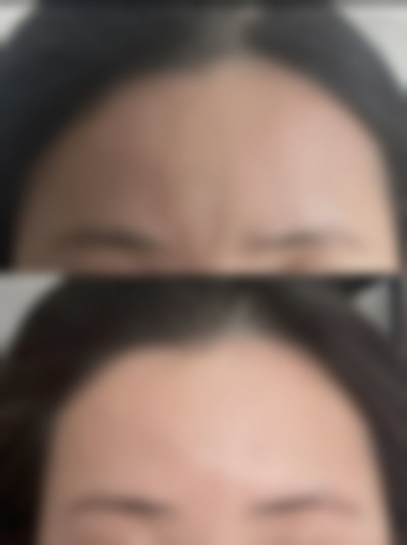 近视手术可以和双眼皮一起做吗？答案是一般不建议，分开做更利于恢复和效果保障！ 