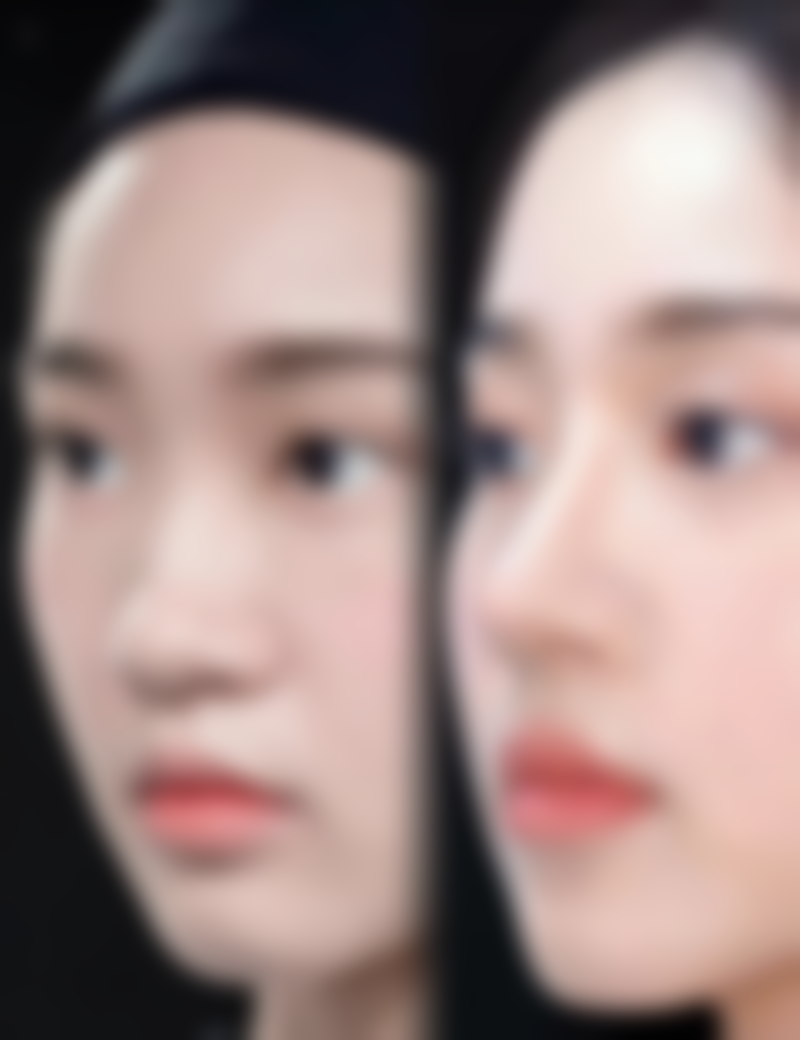 出现什么情况说明割双眼皮一个月不对称不正常呢？