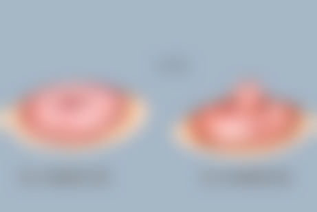 手术刀口疤痕修复的至佳时间是怎样的?