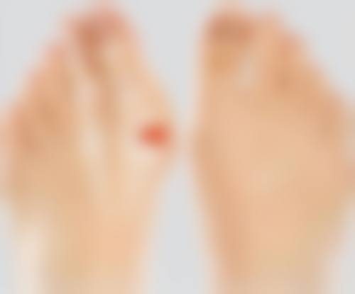 什么情况下需要考虑激光治疗来去除白色疤痕呢？