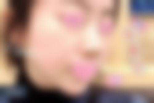 摔伤疤痕什么时候进行祛疤治疗好?