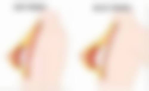 结构型眼袋不熬夜能消除吗？