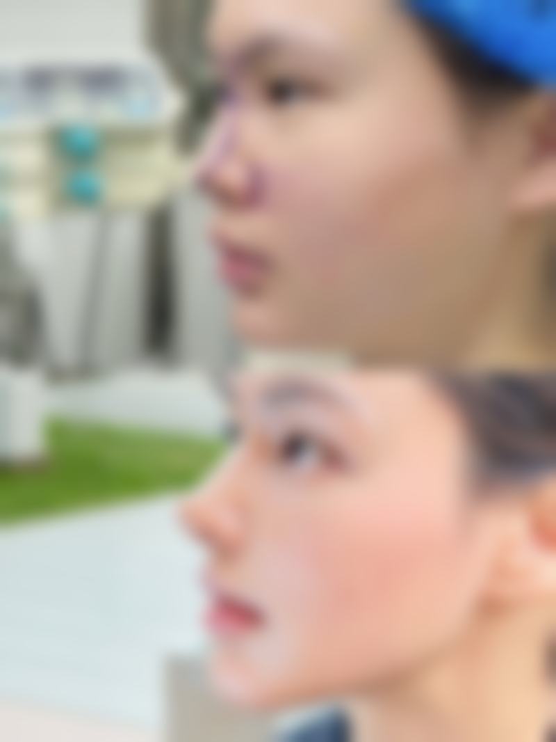 大腿抽脂后怎样做有利于修复正常走路？