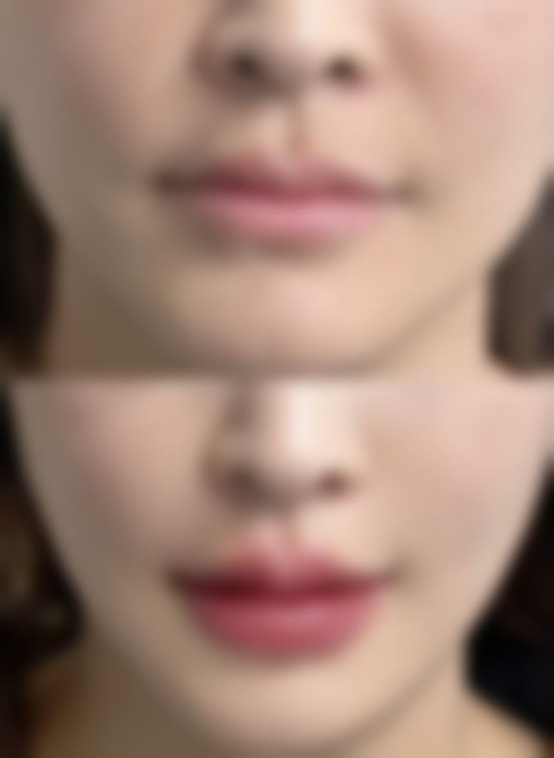 怎么才能清除眼袋？按摩、热敷、医美手段，哪种方法能真正让你告别“泡泡眼”？ 